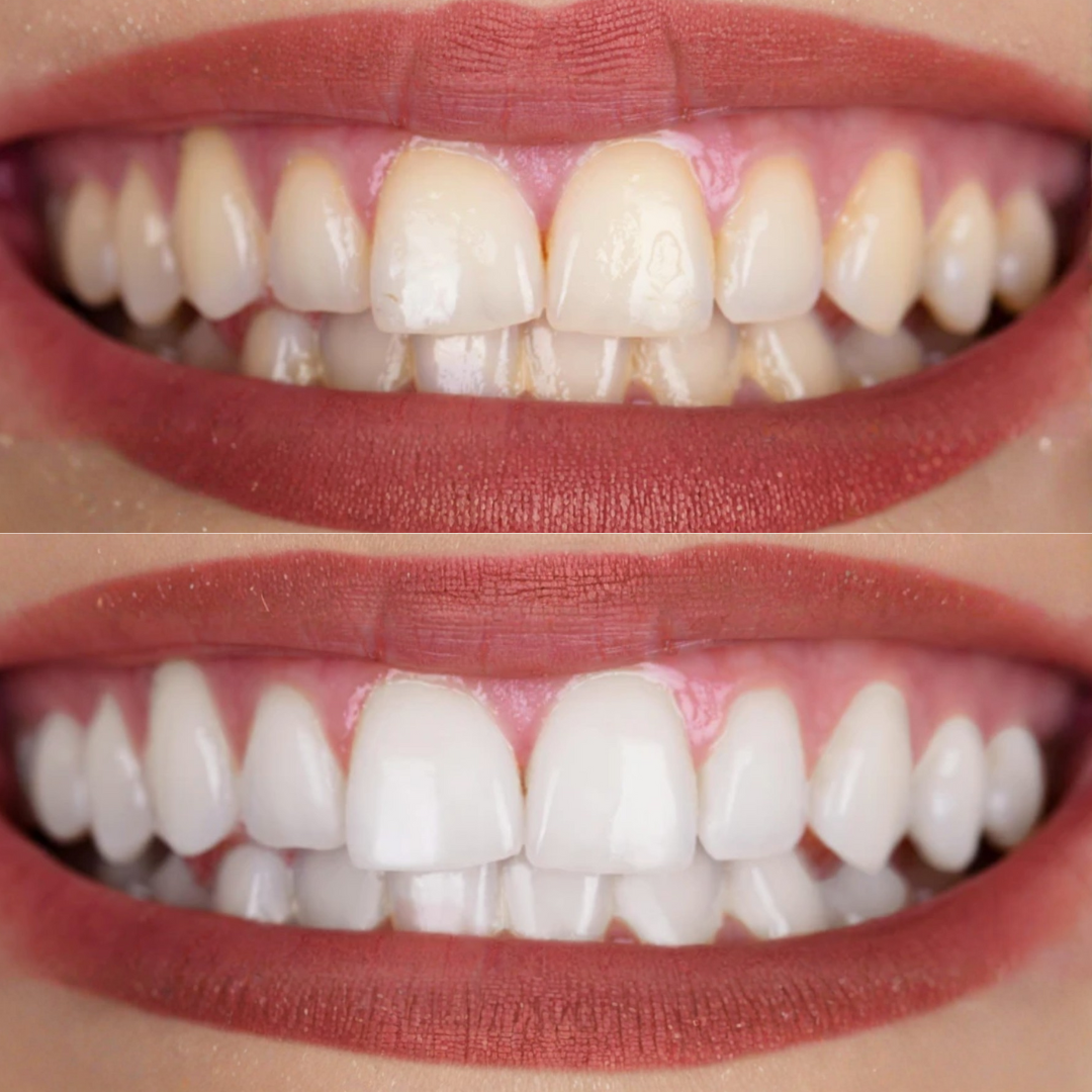 sérum blanchissant V34