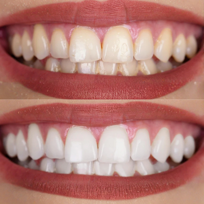 sérum blanchissant V34